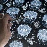 Fármaco invierte síntomas de Alzheimer en pruebas científicas