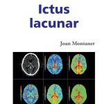Guía Completa sobre el Infarto Lacunar
