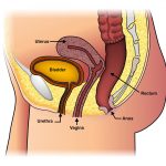 Guía Completa sobre el Prolapso Rectal