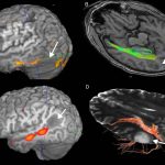 Impacto de la lesión cerebral en alexia y agrafia