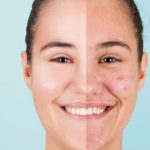 Impacto del Estrés en la Salud de tu Piel