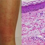 Impacto del Mixedema en la Salud y su Tratamiento