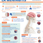 Impacto y tratamiento de la meningitis en la salud global