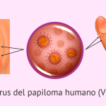 Información esencial sobre el virus del papiloma humano