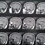Profundiza en la microangiopatía cerebral: causas síntomas y tratamiento