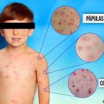 Profundiza en todos los aspectos de la mielitis transversa