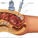 Revela lo esencial sobre la amniocentesis en el embarazo