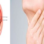 Síntomas reveladores del cáncer de garganta