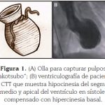 Tako-Tsubo: Todo sobre esta miocardiopatía