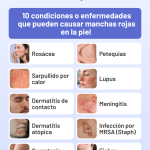 Causas y Soluciones para Manchas Rojas en la Piel