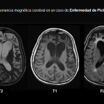 Conoce más sobre la Enfermedad de Pick