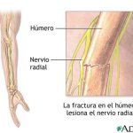 Conoce todo sobre el nervio radial