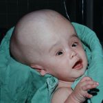 Hidrocefalia: causas síntomas y tratamientos imprescindibles