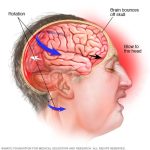 Impacto y prevención de la encefalopatía traumática crónica