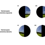 La Hemianopsia: causas diagnósticos y tratamientos esenciales