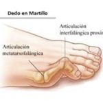 Profundiza en la neuropatía sensitiva: causas y tratamientos