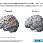 Razones de la hiperconectividad cerebral en el autismo infantil