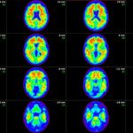 Revelan fuente del 30% de placas amiloides en Alzheimer