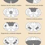 Aspectos clave del síndrome de Brown-Séquard