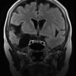 Impacto del síndrome amnésico isquémico hipocampal completo
