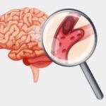 Variedades de accidente cerebrovascular: una guía esencial